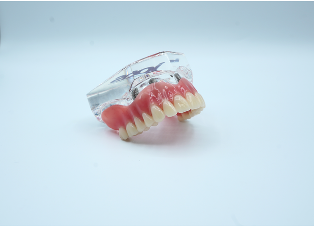 4 Implant Upper Overdenture Jaw Model