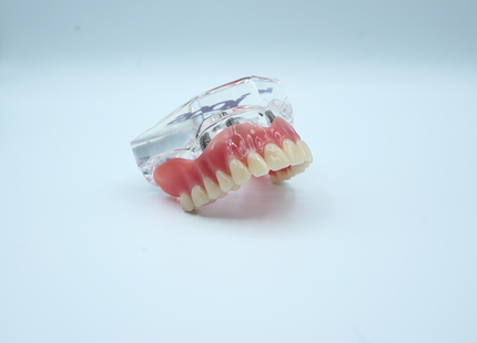 4 Implant Upper Overdenture Jaw Model