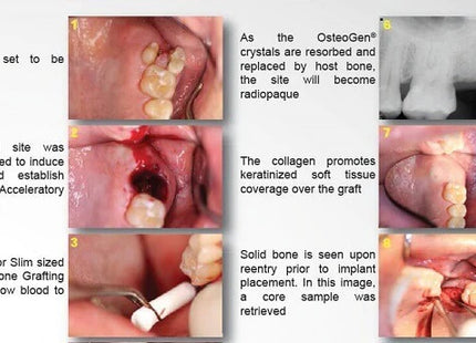 OsteoGen Bone Grafting Plug, Large (10x20mm), Pack of 10